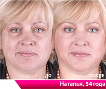 Мой муж, а он старше меня, тоже захотел попробовать Стэм Сэлл Терапи, теперь и он молодеет и хорошеет, пользуясь им регулярно.